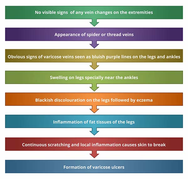 Symptoms of Varicose Veins