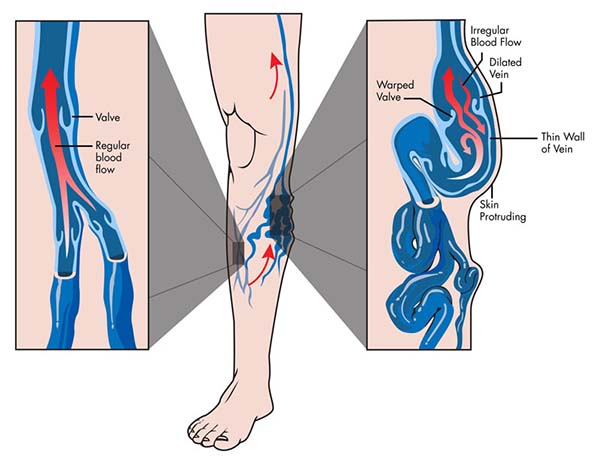 Definition of Varicose Veins