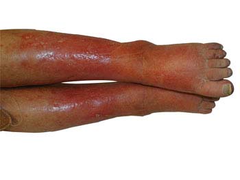 Similar conditions of Varicose Veins