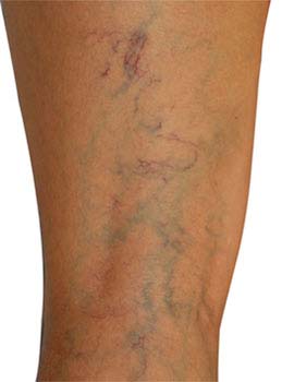  Similar conditions of Varicose Veins