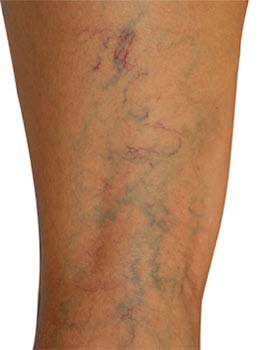 Similar conditions of Varicose Veins