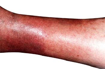 Similar conditions of Varicose Veins
