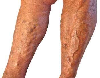 Summary of Varicose Veins