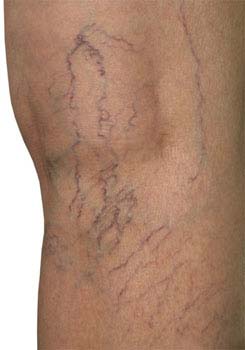 Symptoms of Varicose Veins