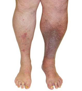 Complications of Varicose Veins