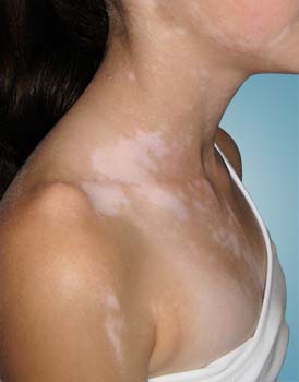 Causes of Vitiligo