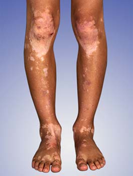 Definition of Vitiligo