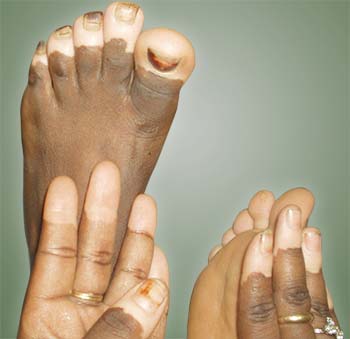 Introduction of Vitiligo