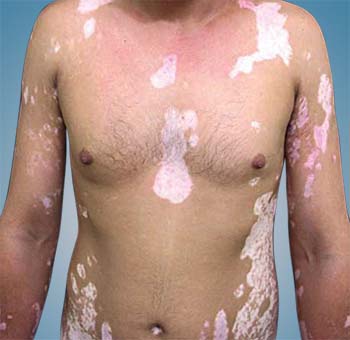 Symptoms of Vitiligo