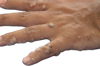 Symptoms of Warts