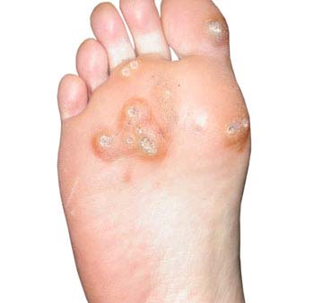 Symptoms of Warts