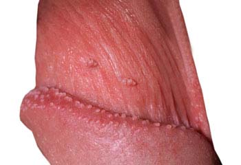 Symptoms of Warts