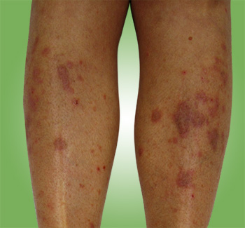 lichen planus definition