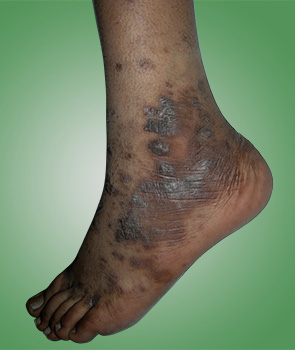 lichen planus introduction