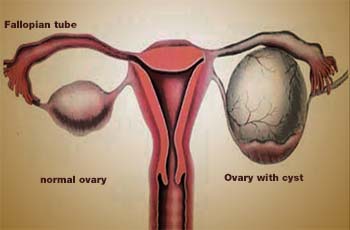 ovarian cyst