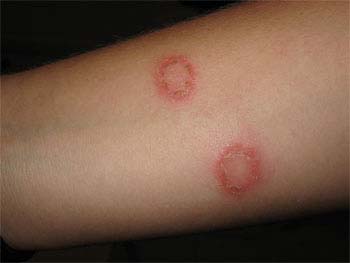Introduction of Ringworm