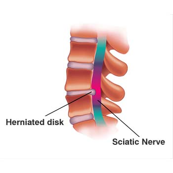 Causes of Sciatica