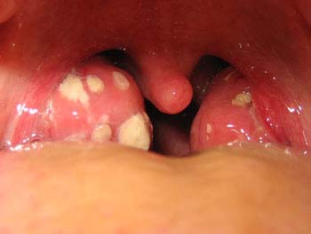 Tonsillitis 