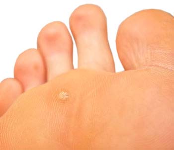 Warts Related Conditions - WelcomeCure Warts Related Conditions