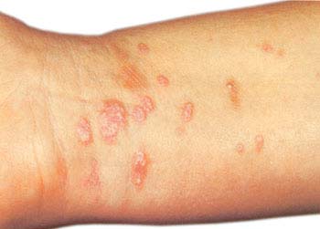 Warts Related Conditions - WelcomeCure Warts Related Conditions