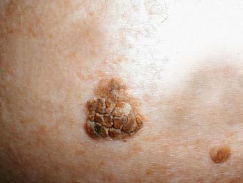 Warts Related Conditions - WelcomeCure Warts Related Conditions