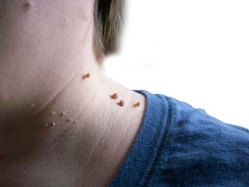 Warts Related Conditions - WelcomeCure Warts Related Conditions