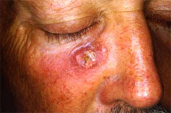 Warts Related Conditions - WelcomeCure Warts Related Conditions