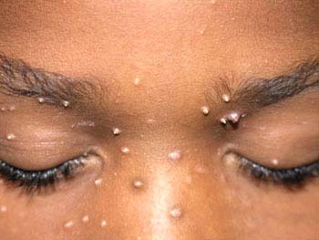 Warts Related Conditions - WelcomeCure Warts Related Conditions