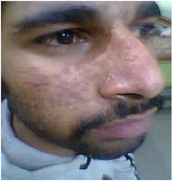 Before Acne Rosacea Img1