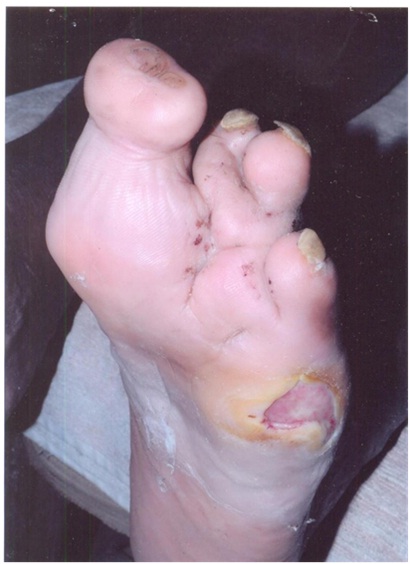 After-Diabetes-Case2-img