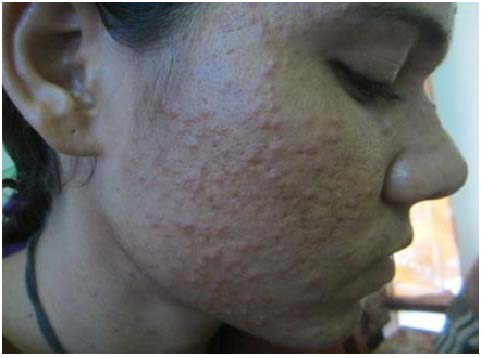 Before Treatment of Eczema