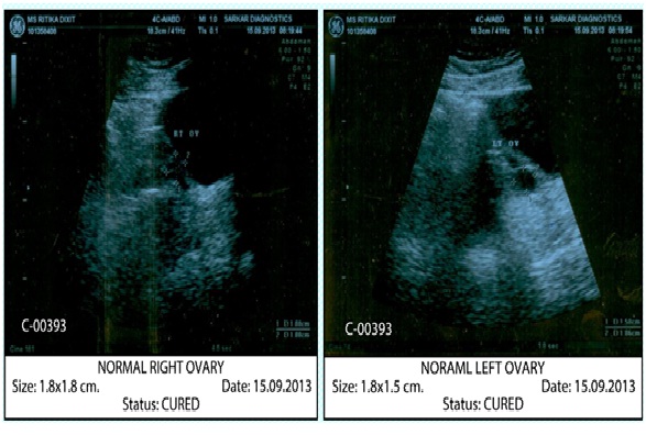 Before Treatment Ovarian cyst case Img1