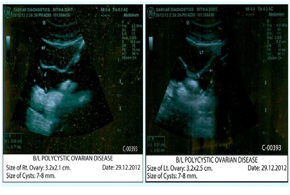 Before Treatment Ovarian cyst case Img1