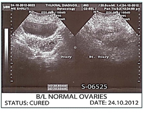 Before Treatment Ovarian cyst case Img1