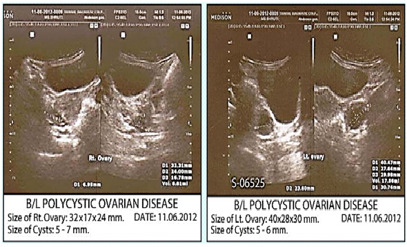 Before Treatment Ovarian cyst case Img1