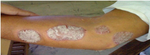 Before Treatment Psoriasis on hand
