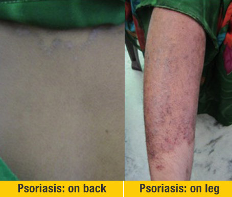 After Treatment Psoriasis on back And Legs