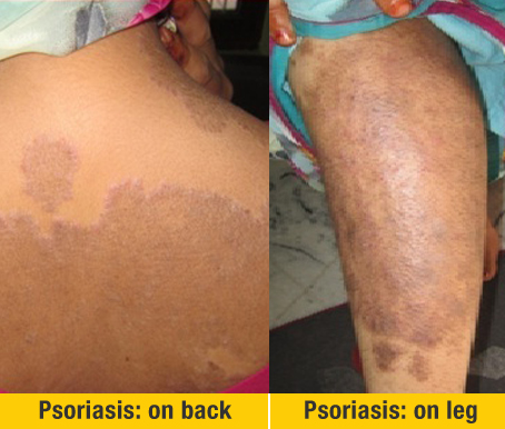 Before Treatment Psoriasis on back And Legs