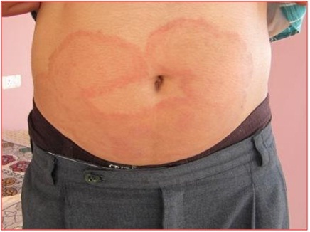 Before Treatment of Tinea